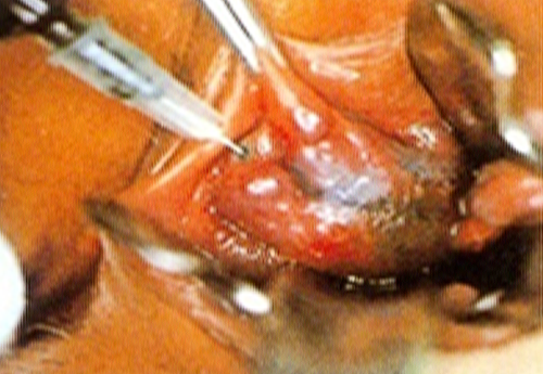 1. 치핵 내에서   ICG 용액을 주입함(색소가 투과되어 보임)